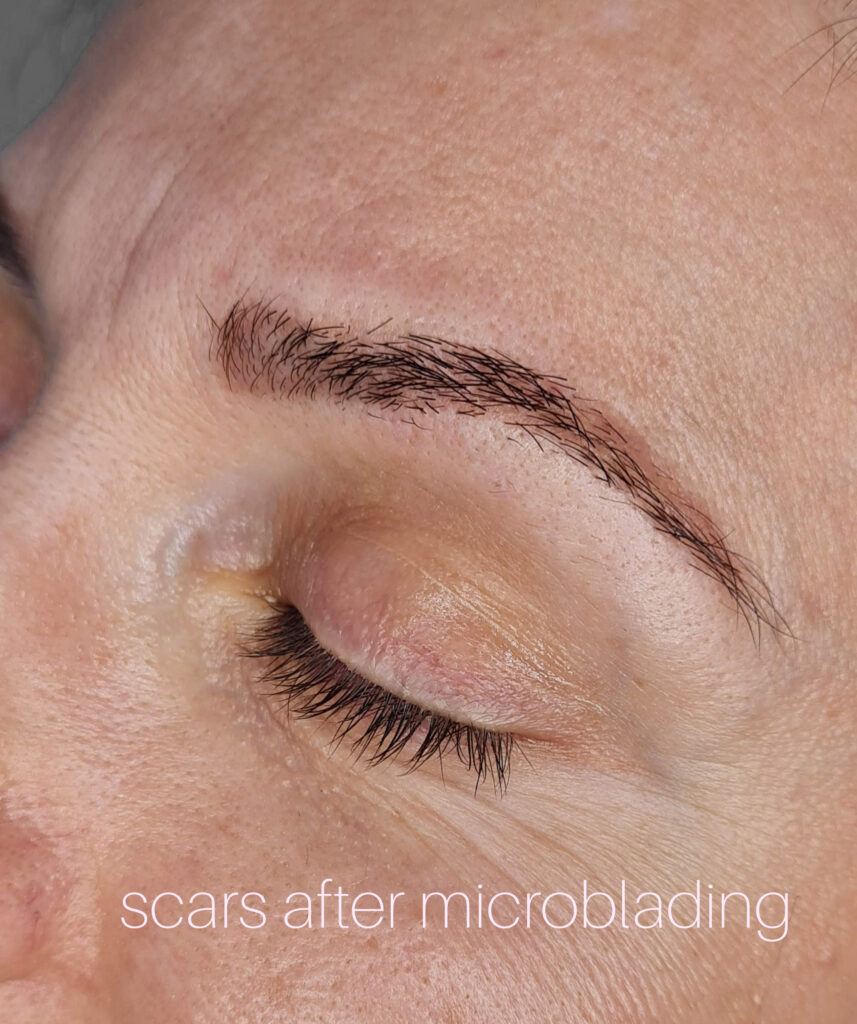 Difference between Microblading and Hairstroke. Scars after microblading in Lucerna